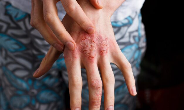 Dermatite Atopica