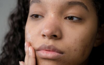 Acne: cos’è e perchè compare