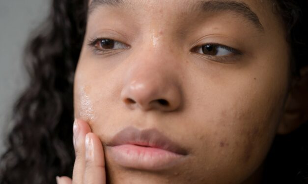 Acne: cos’è e perchè compare