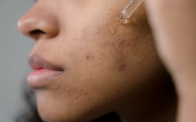 Acne: cosa fare?